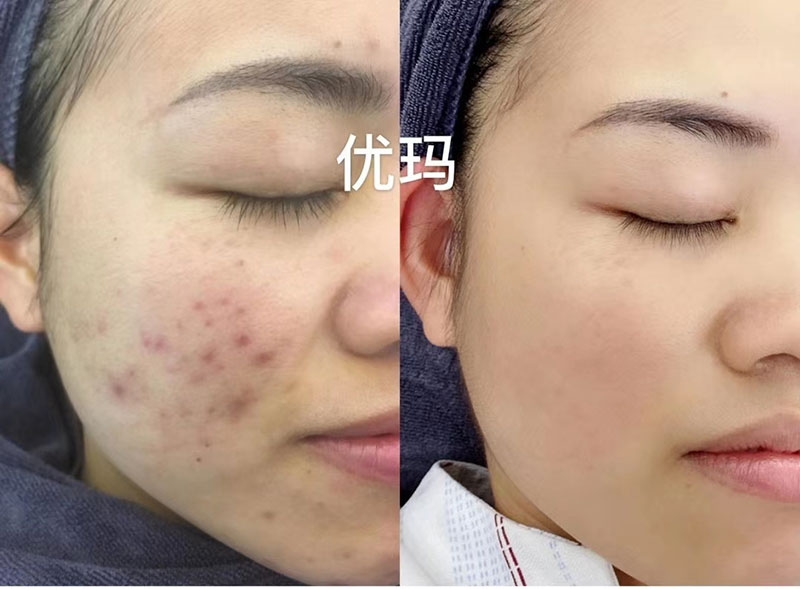 疤痕修复案例