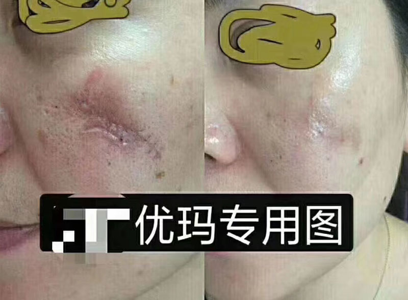 疤痕修复案例