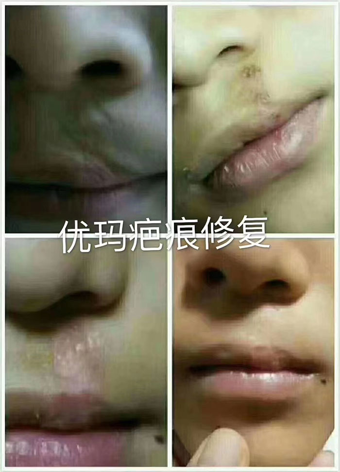 疤痕修复案例